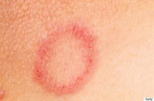 How Athletic Body Care Soap Bars Help Prevent Ringworm